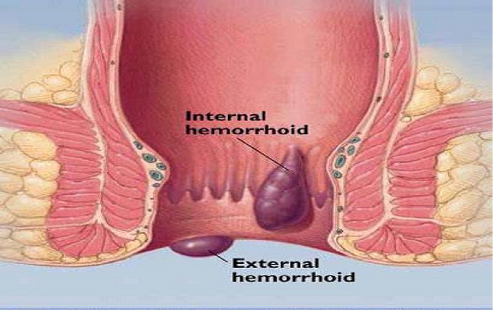 Hemorrhoids Surgery Dubai | Piles Treatment in Dubai