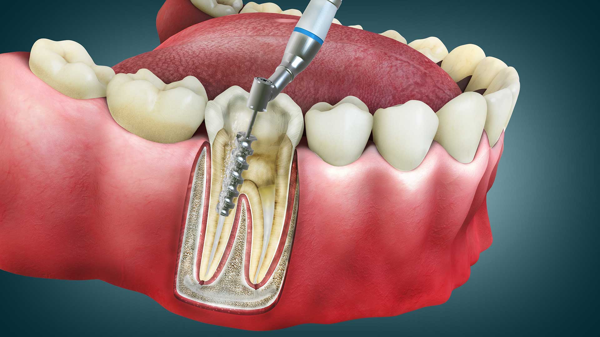 A Closer Look at Endodontic Treatments in Mississauga | Education