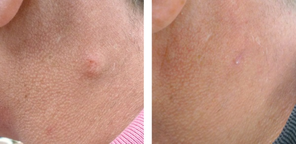 How a dermatologist removes cysts safely and quickly -