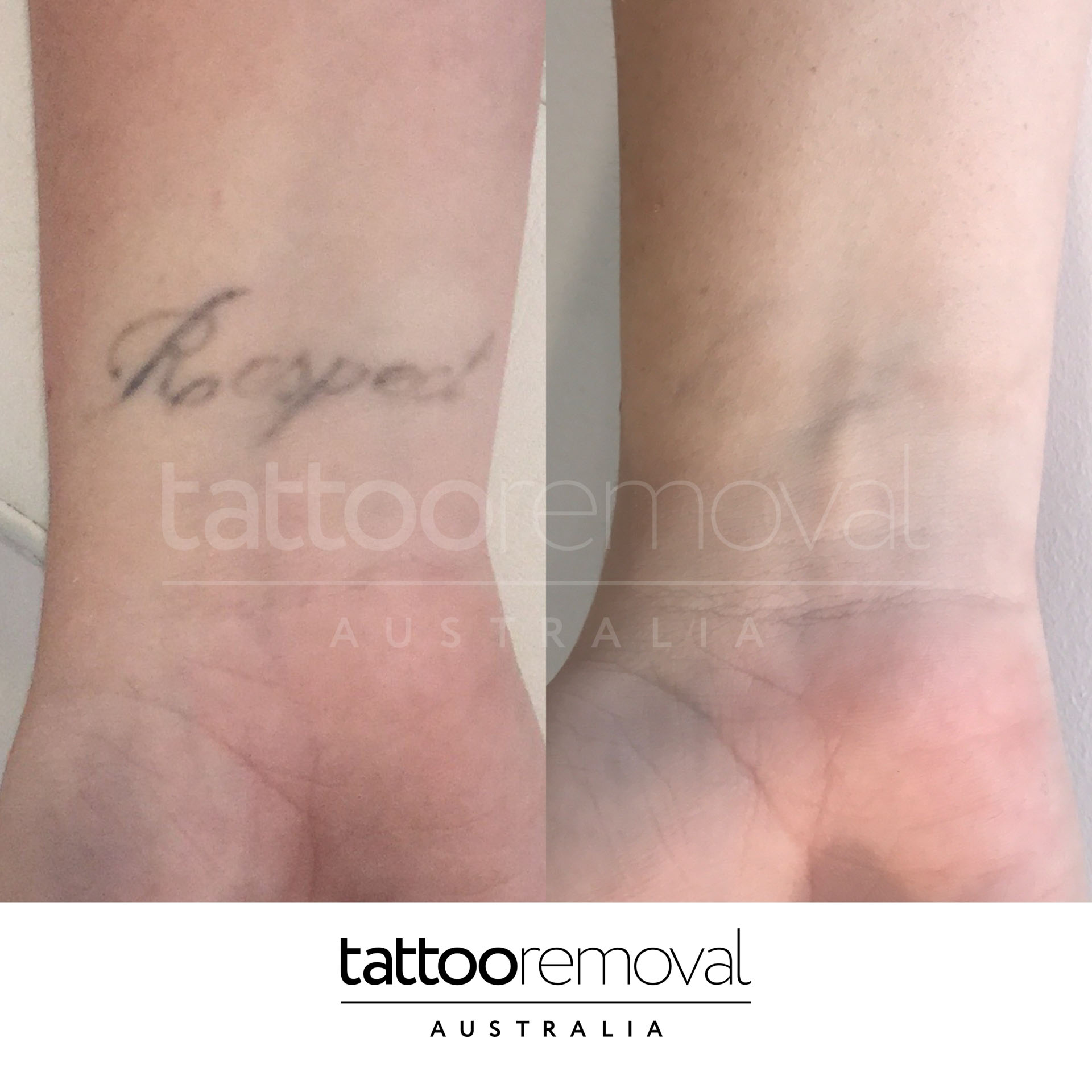 Cosmetic Tattoo Removal Brisbane | Eyebrow Tattoo Removal