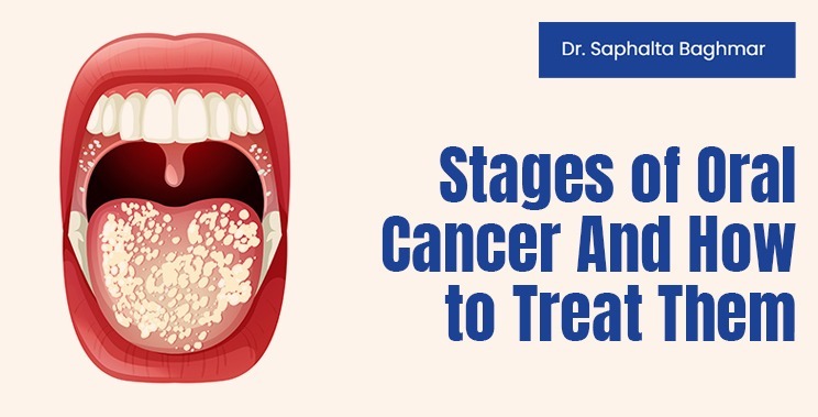 Stages Of Oral Cancer And How To Treat Them | Dr. Saphalta Baghmar