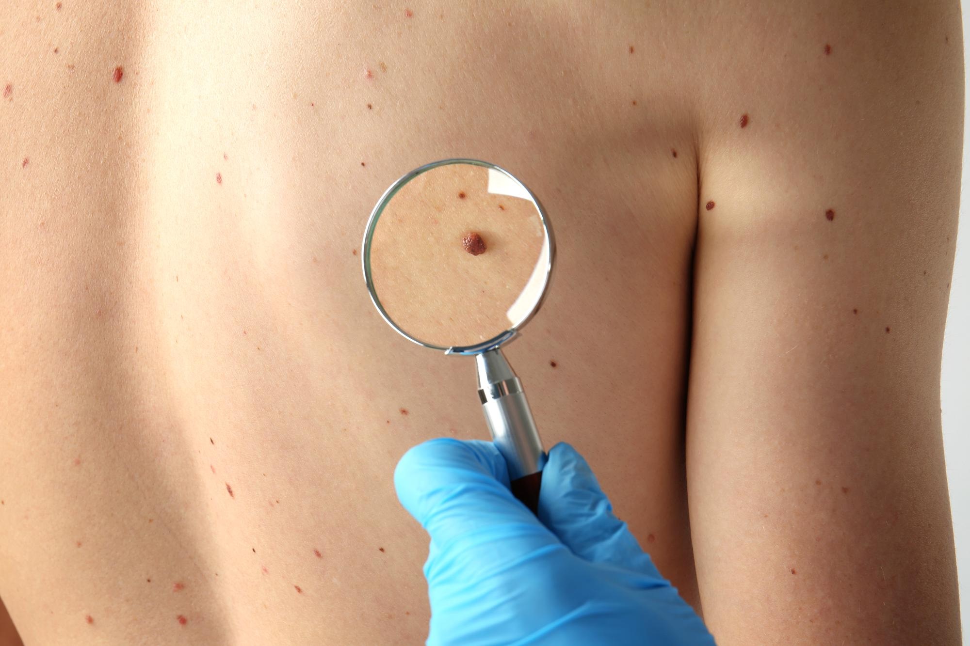 How Much Does Skin Tag Removal Cost in the UK? Full Guide