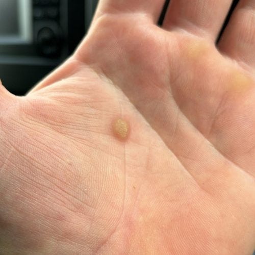 Types of Warts and the Best Removal Method | by A.H.Advanced Skin Specialist | Jun, 2025 | Medium