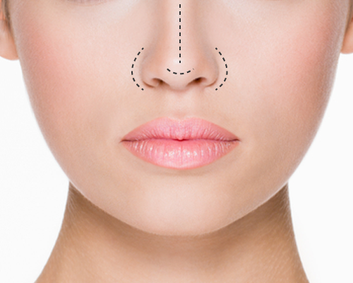 Nose Fillers | Non-Surgical Rhinoplasty Treatment Isle of Man | Dr. Ram Aesthetics