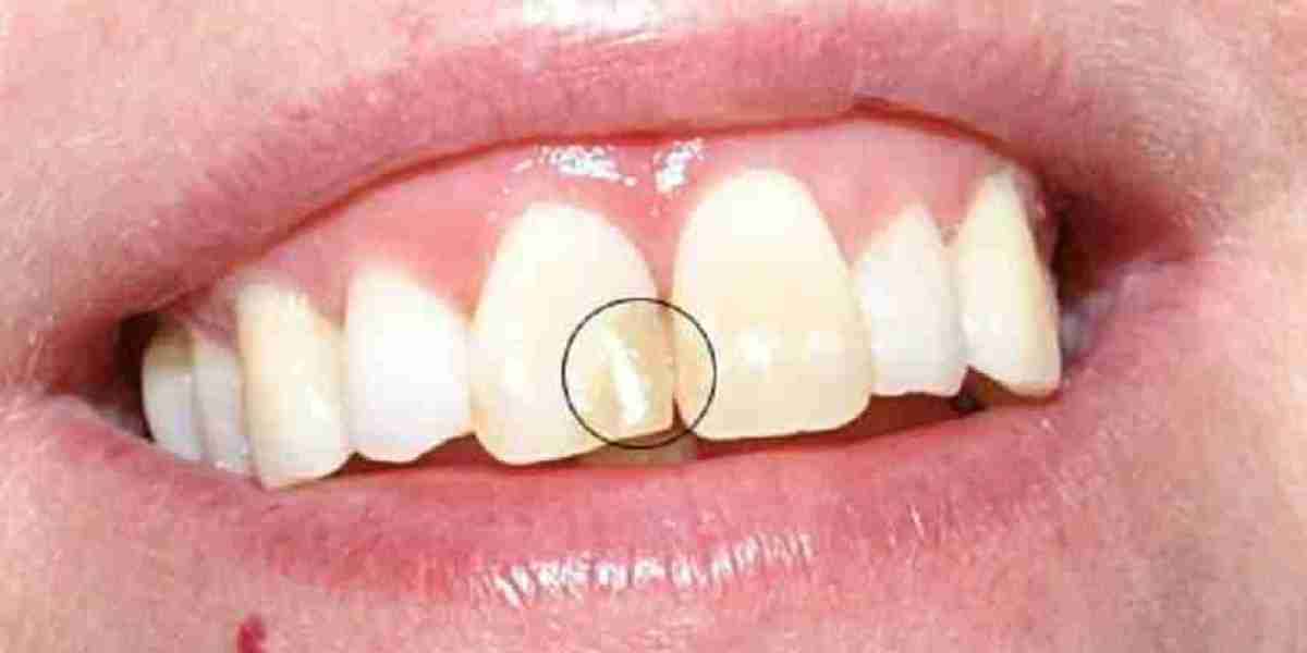 Trám răng mất bao lâu? Giải đáp từ chuyên gia phục hình tại Nha khoa Sing