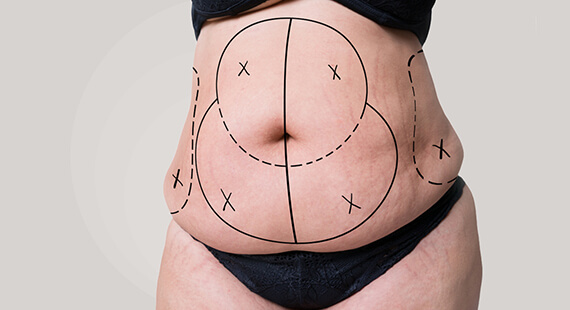 Abdominoplasty or Tummy Tuck Surgery Cost in Delhi - Dr Rajat Gupta