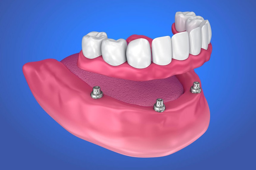 Blogs - Bang Box online - All-on-4 Dental Implants: What Nashville Patients Should Know in 2025