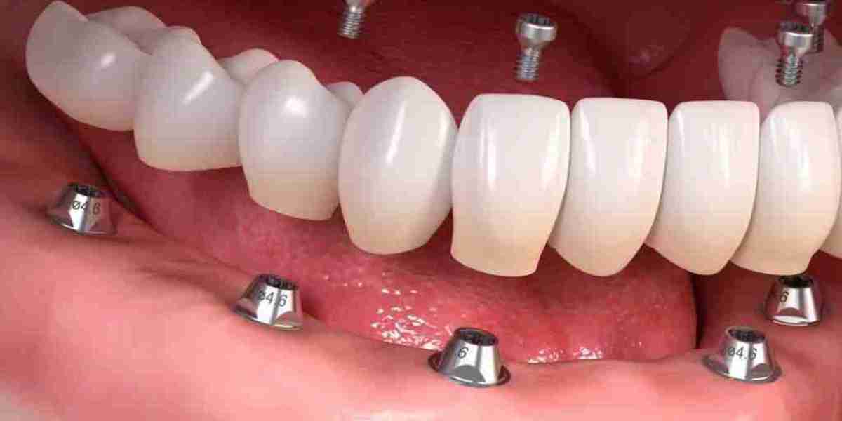 Kies voor zekerheid met tandheelkundige implantaten: Een complete gids