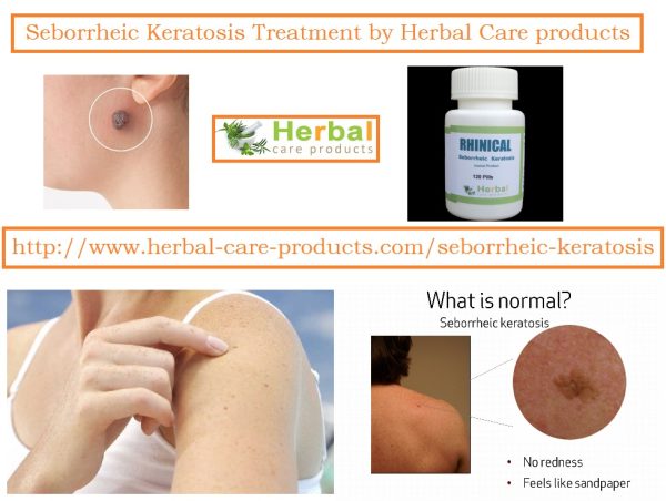 10 Natural Remedies for Seborrheic Keratosis - Herbal Care Products - Blog