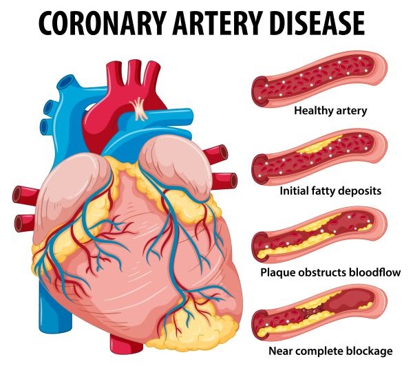 Early Signs of Coronary Artery Disease You Should Never Ignore