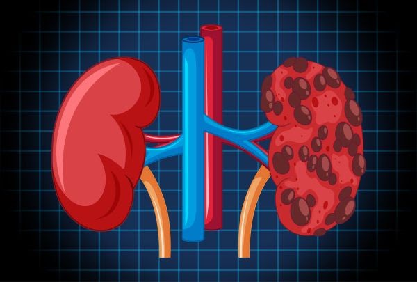 Understanding Kidney Cancers: Causes, Symptoms, and Risk Factors