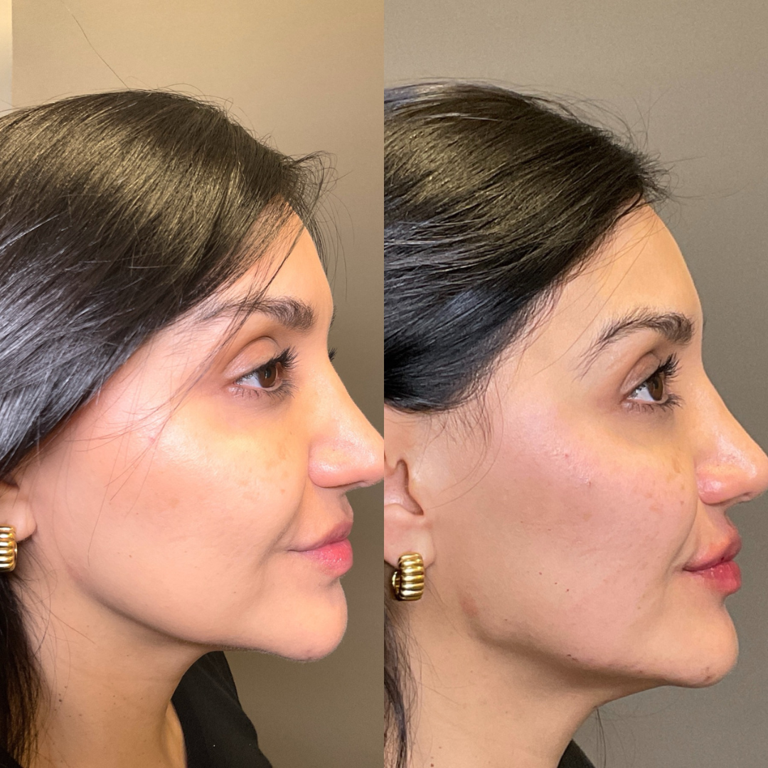 Whizolosophy | Best Guide to Laser Hair Removal in Mississauga