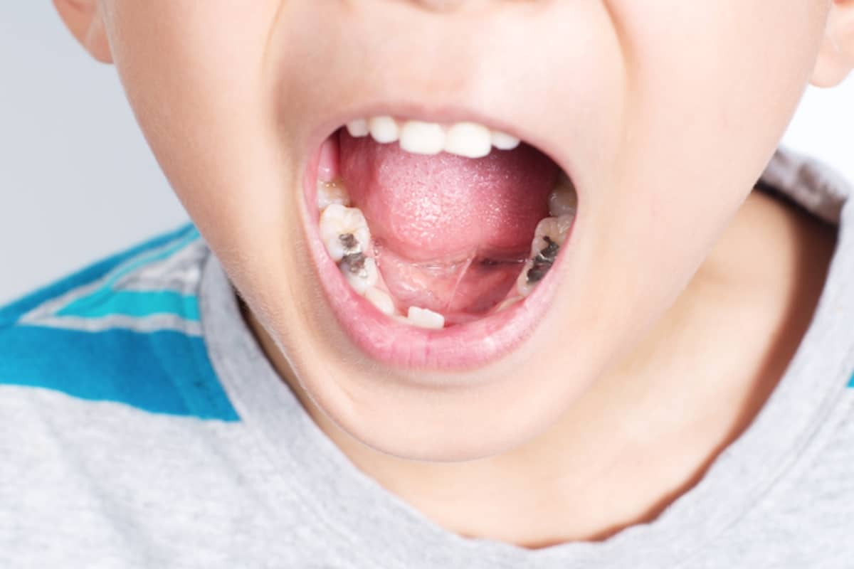 Early Cavity Prevention in Kids: Why It Matters for Lifelong Oral Health – BDnews55.com