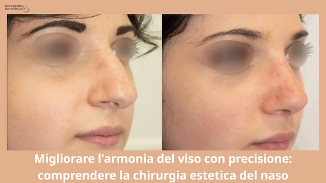 Migliorare l'armonia del viso con precisione: comprendere la chirurgia estetica del naso | PPTX