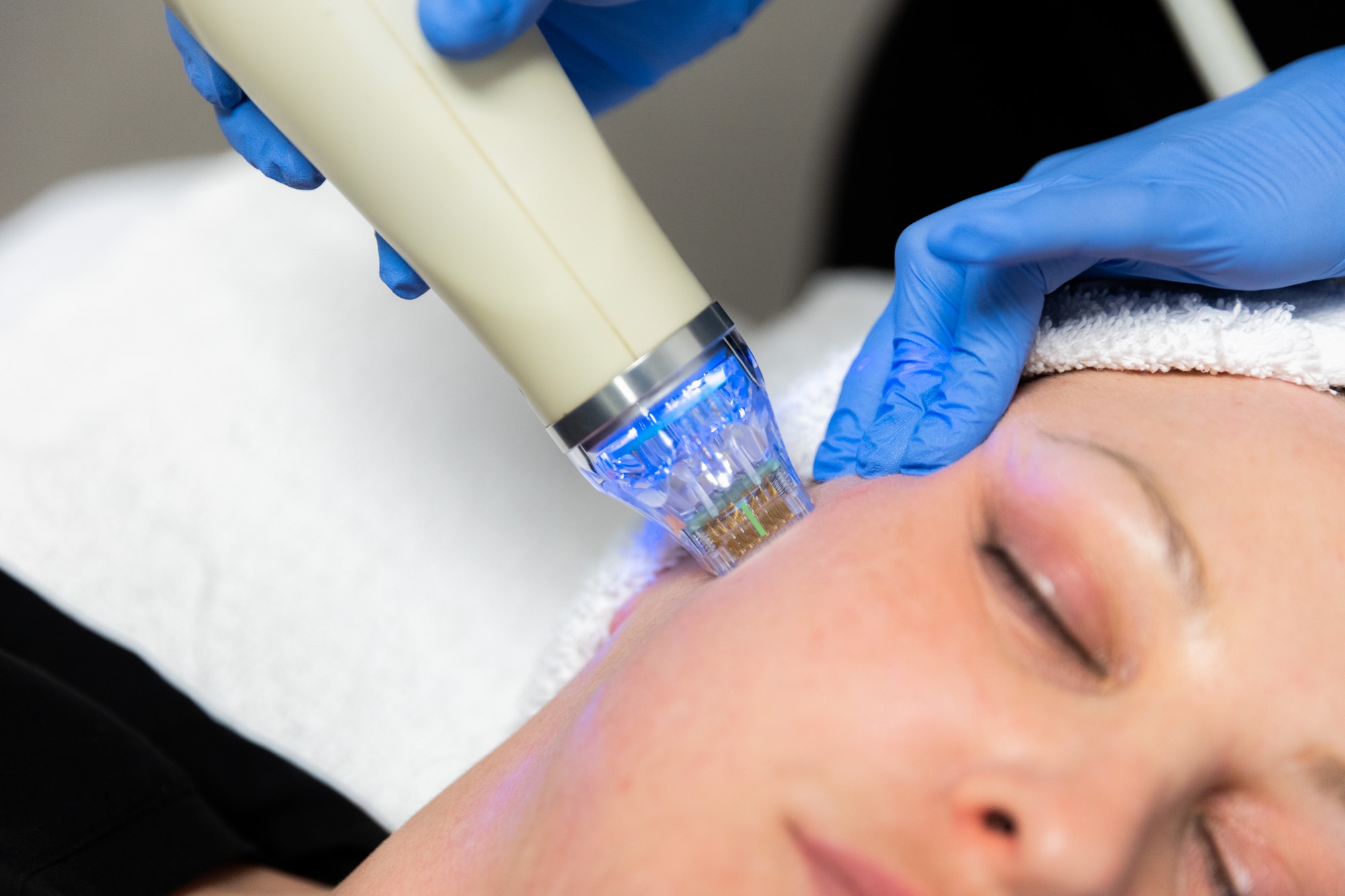 Revitalise Your Skin With RF Microneedling Treatment In London - Ink Illusions
