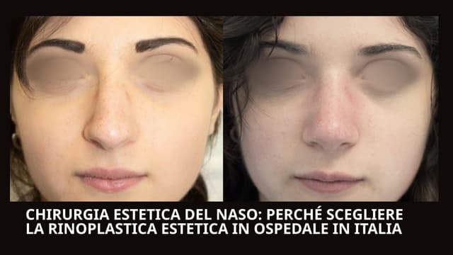Chirurgia estetica del naso: perché scegliere la rinoplastica estetica in ospedale in Italia | PPTX