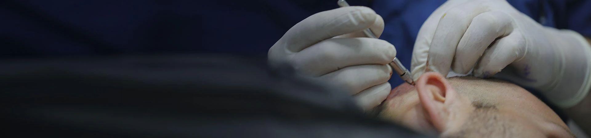 Afro Hair Transplant in Turkey Explained: The Science Behind Natural Results -  TheOmniBuzz