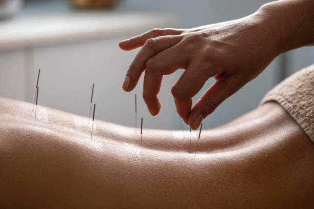 Acupuncture for Hormonal Imbalance: How Traditional Techniques Support Modern Health