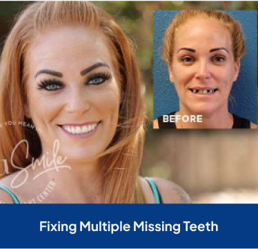 Dental implants Pittsburgh - Montour Oral Surgery