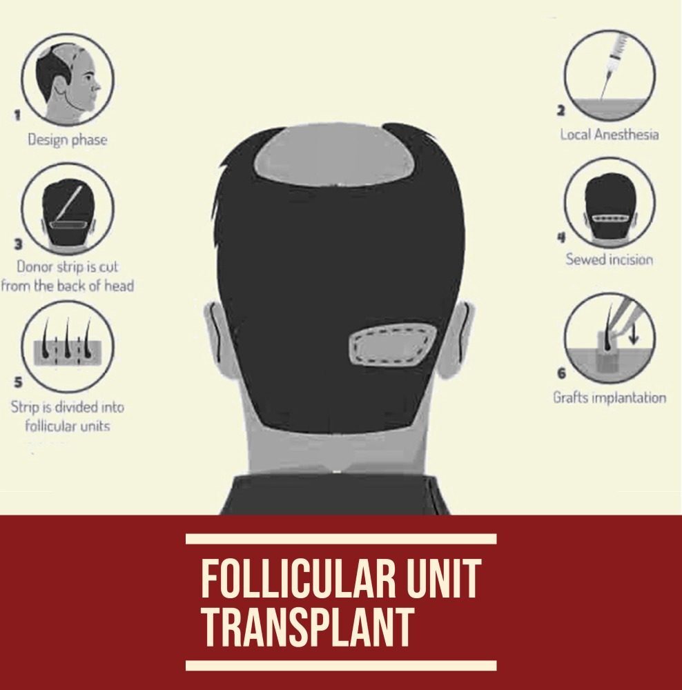 fut hair transplant delhi - Crown - The Hair Transplant Experts
