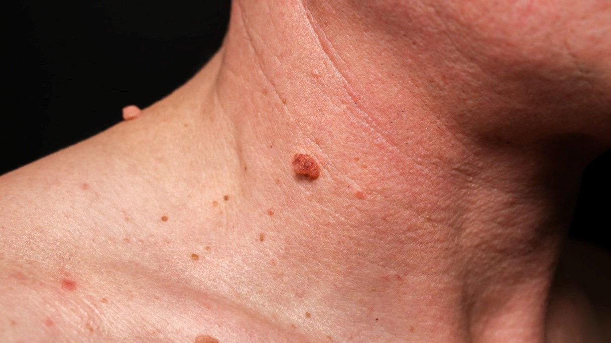 Are Skin Tags Harmful or Are They Just a Cosmetic Concern