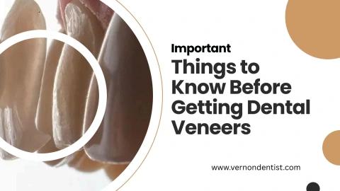 Important Things to  Know Before Getting Dental Veneers