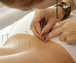 Top Rated Chinese Acupuncture In Brisbane, Milton | Chiropractix