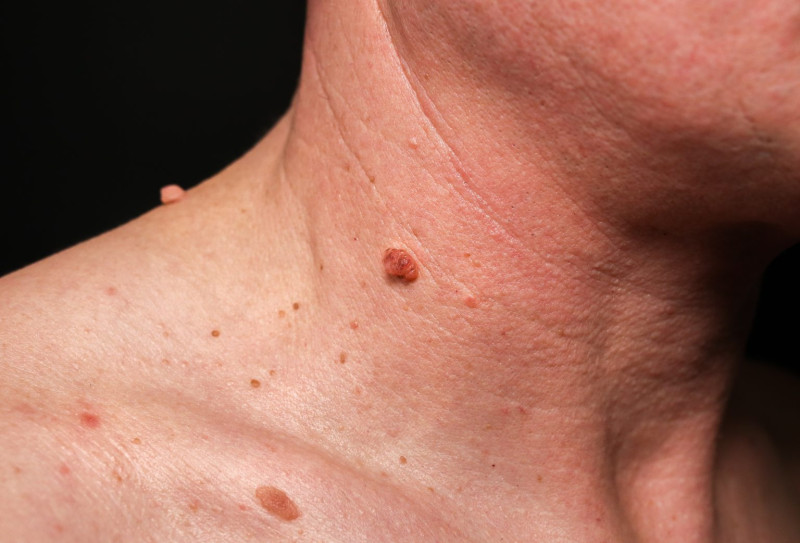 When Does a Skin Tag Become a Medical Concern?: skintreatmentmk — LiveJournal
