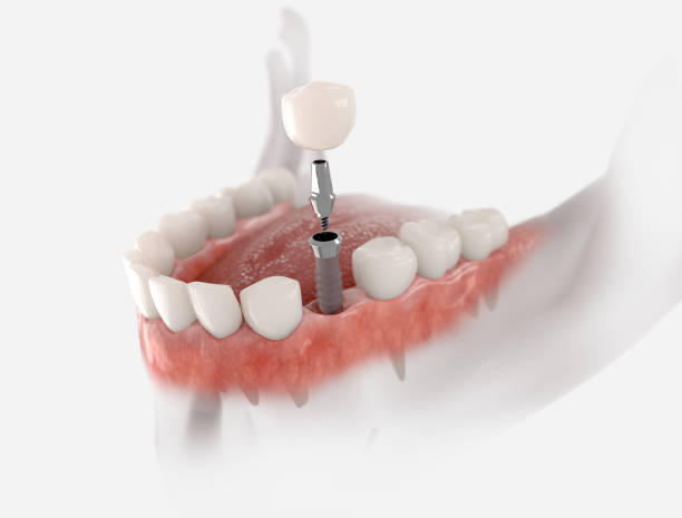 Dental Implants Miami - Deluxe Smile Design | Tooth Replacement
