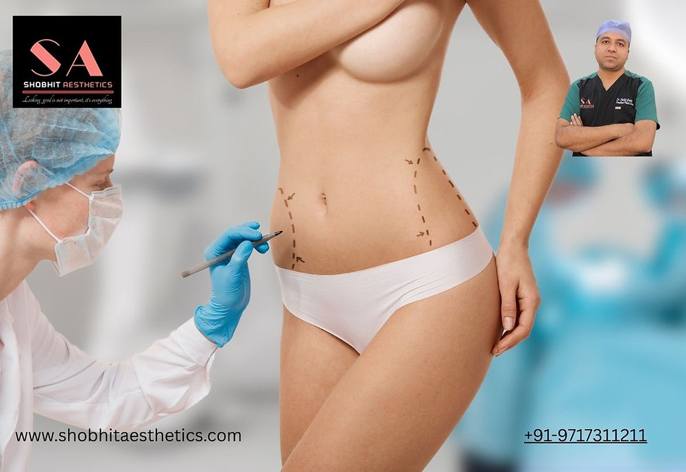 Liposuction in Delhi: What It Can Actually Do for Your Body