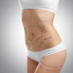 liposuction in Riyadh saudia
