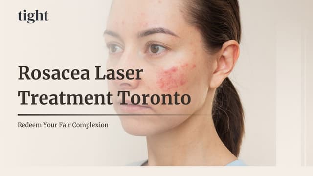 Personalized Rosacea Laser Treatment Toronto | PPTX