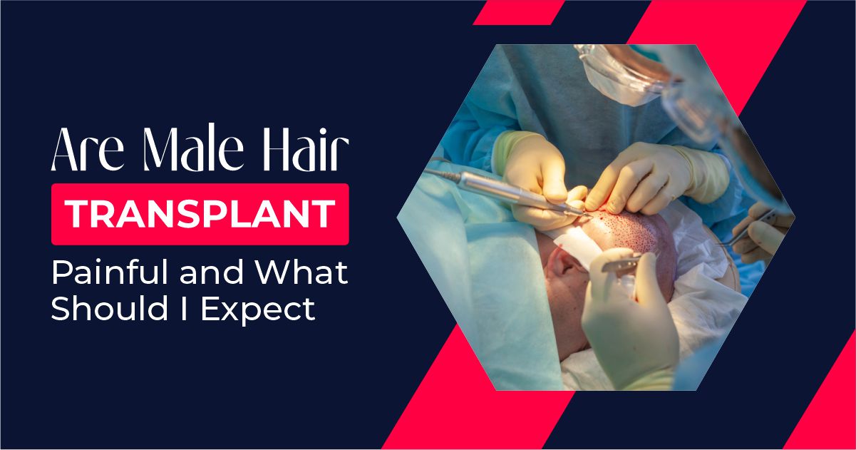Are Male Hair Transplant Painful and What Should I Expect – Best Hair Transplant Clinic in Delhi, India