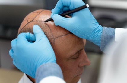 Hair Transplant vs SMP: Cost, Results and Recovery Compared