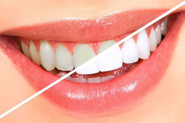 Best Teeth Whitening Dentist Canberra, Zoom Teeth Whitening Canberra