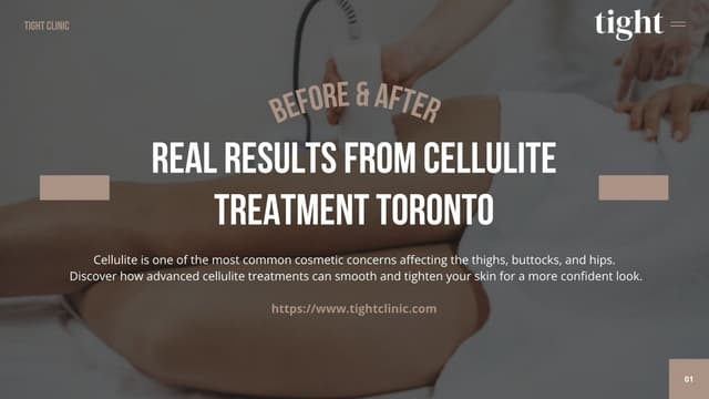 Cellulite Treatment Toronto Before and After Results | PPTX
