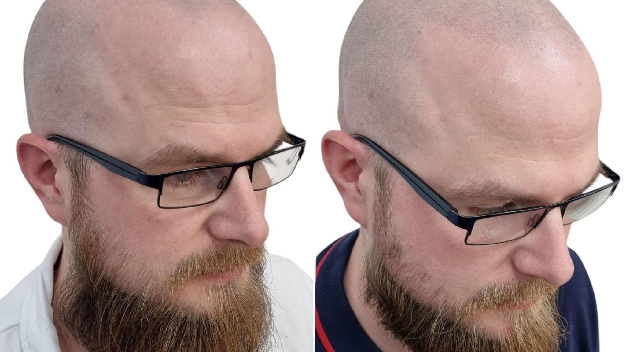 What Are The Advantages of the Scalp Micropigmentation?