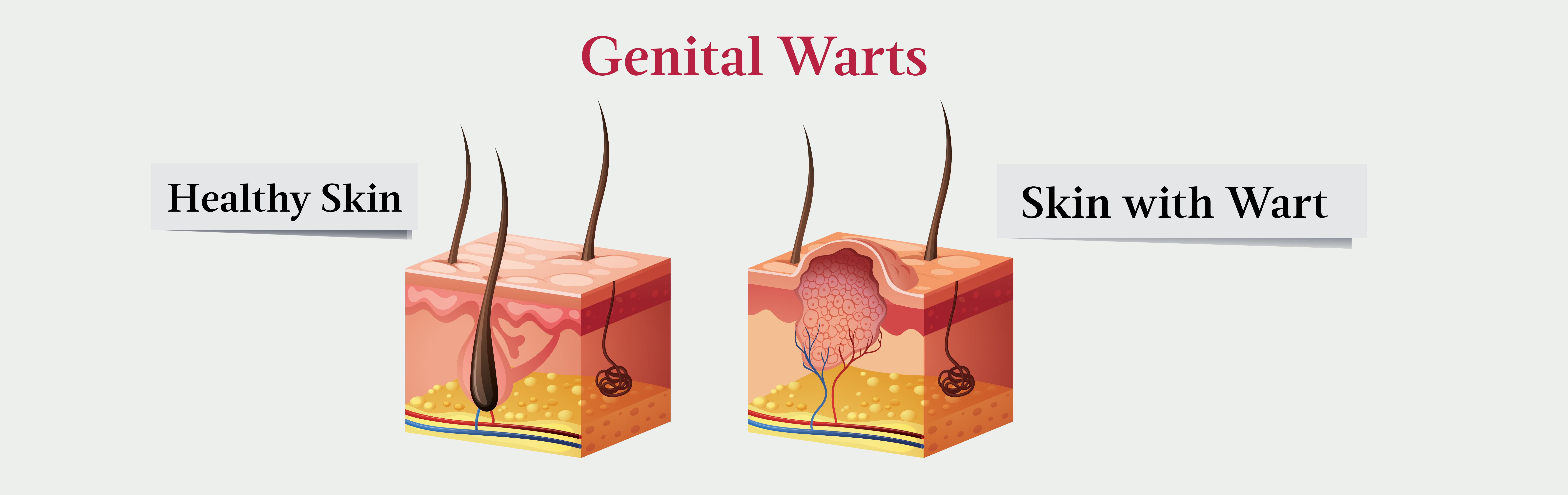 How To Prevent The Spread Of Genital Warts?