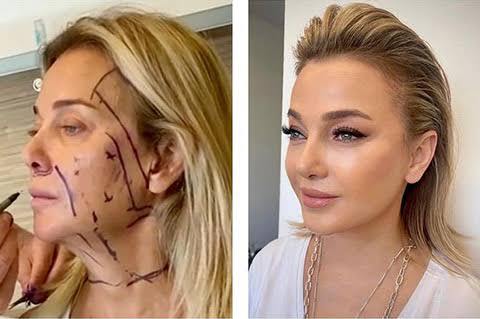 How Can a Deep Plane Facelift in Kitchener Restore a Youthful Look? – @dratiyahplastic4 on Tumblr