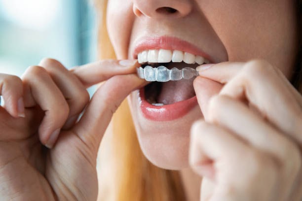 Achieve a Confident Smile with Santa Monica Invisalign Treatment