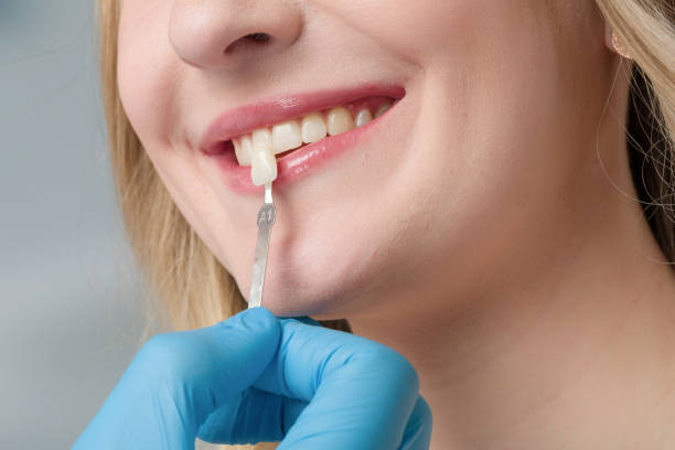 Custom Porcelain Veneers Park Ridge IL - JustPaste.it