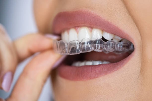 Invisalign Rochester: A Smile Makeover for Young and Old, Your Modern Orthodontic Practice