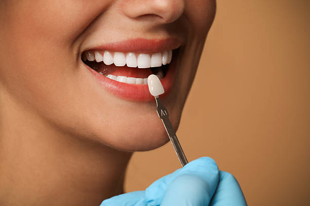 Transform Your Smile With Veneers: A Modern Solution for Lasting Confidence | Davis and Engert Dentistry