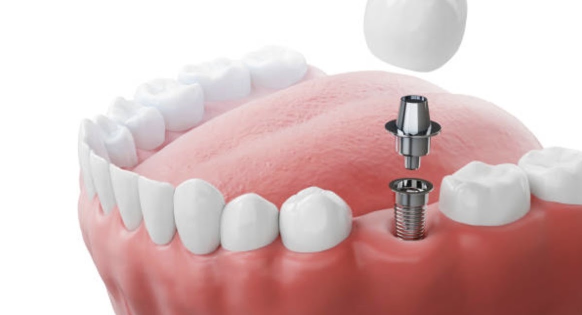 Stoddard Dental Square: Restore Your Smile with Dental Implants in Mount Roskill, Auckland