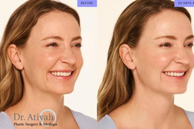 Where Can You Get Safe and Professional Botox  in Waterloo Treatment? | Articles | Dr Atiyah Plastic | Gan Jing World - Technology for Humanity | Video & Movie Streaming