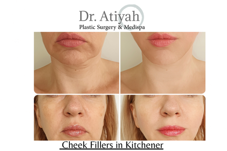 What Are Cheek Fillers in Kitchener and Why Choose Professional Treatment?