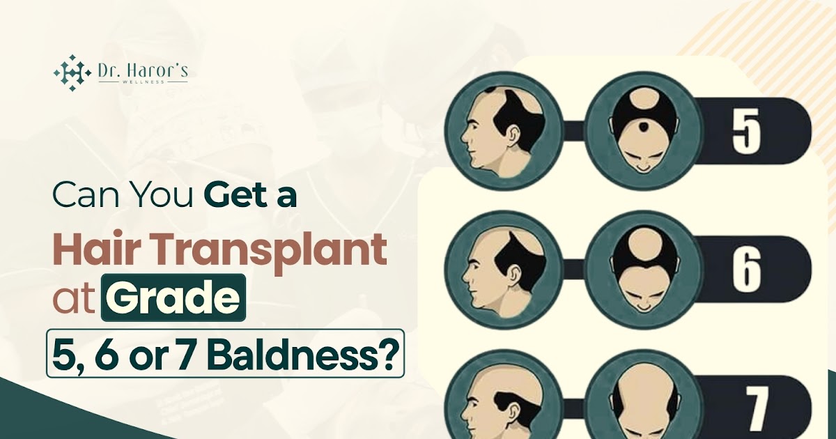 Can You Get a Hair Transplant at Grade 5, 6 or 7 Baldness?