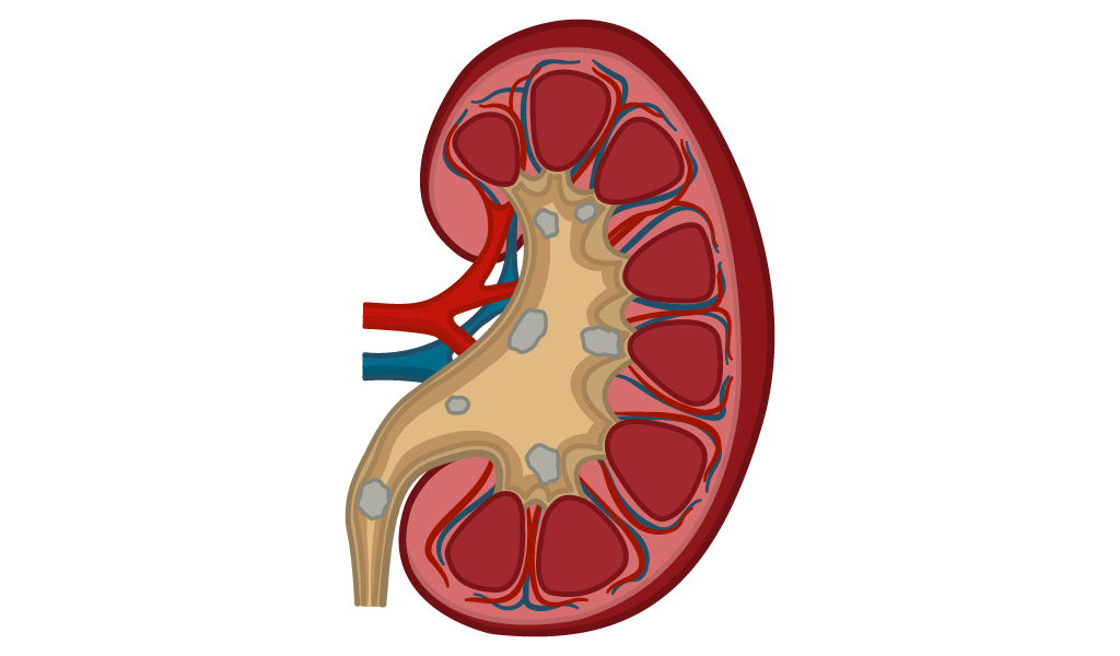 Kidney Stone Treatment In Jaipur | Kidney Stone Doctor In Jaipur
