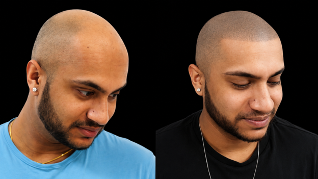 Head Tattoos for Hair Loss: How to Achieve the Appearance of a Fuller Head of Hair
