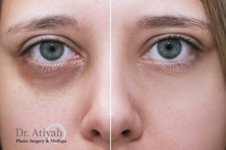 What to Know Before Choosing Under-Eye Fillers in Kitchener